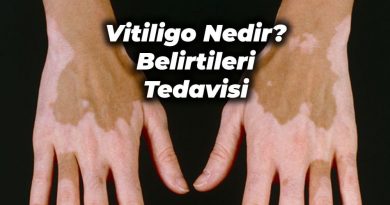 vitiligo tedavisi